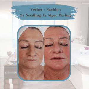 Botox Alternative
